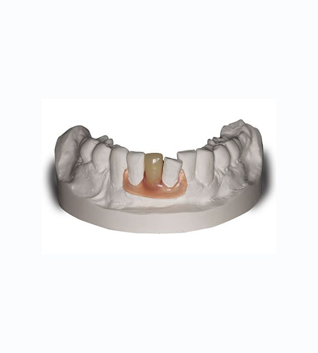 Model of a Person 's Teeth With a Tooth Missing — Cosmetic Denture Services–Jacob Maxwell in Mackay, QLD