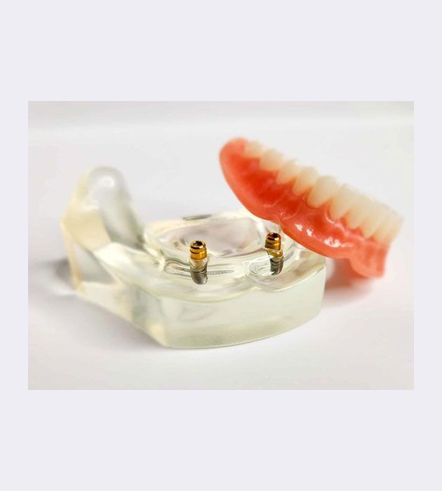 Model of a Denture With Dental Implants in It — Cosmetic Denture Services–Jacob Maxwell in Mackay, QLD