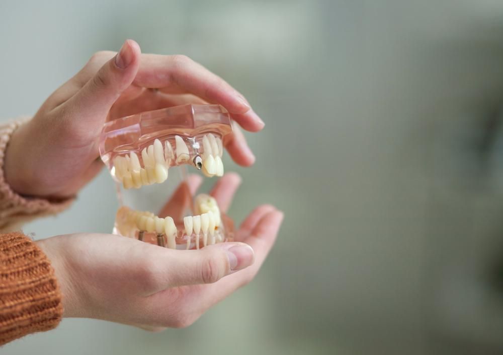 A Person Is Holding a Model of A Person 's Teeth in Their Hands — Cosmetic Denture Services–Jacob Maxwell in Proserpine, QLD