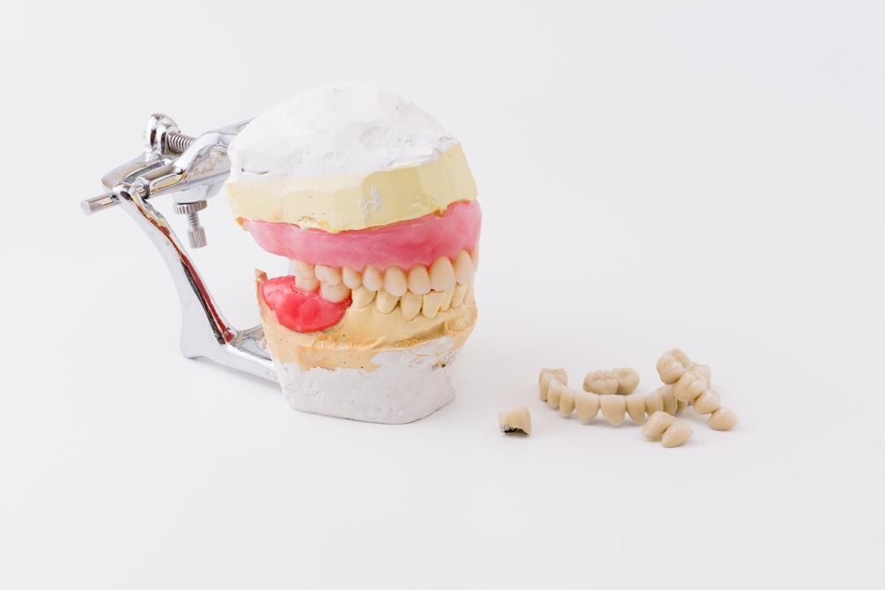A Model of A Tooth with A Missing Tooth Next to A Pile of Teeth — Cosmetic Denture Services–Jacob Maxwell in Sarina, QLD