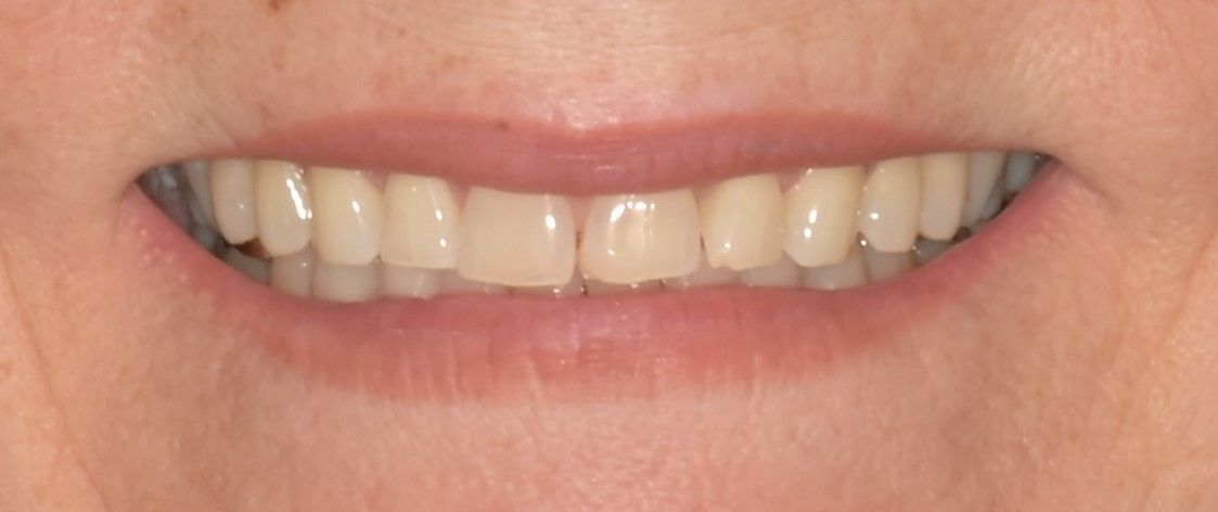 A close up of a woman 's smile with white teeth.