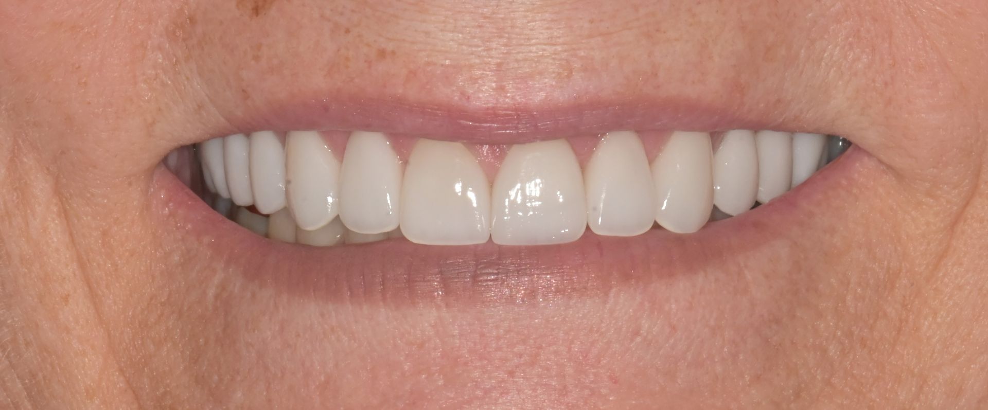 A close up of a woman 's smile with white teeth.