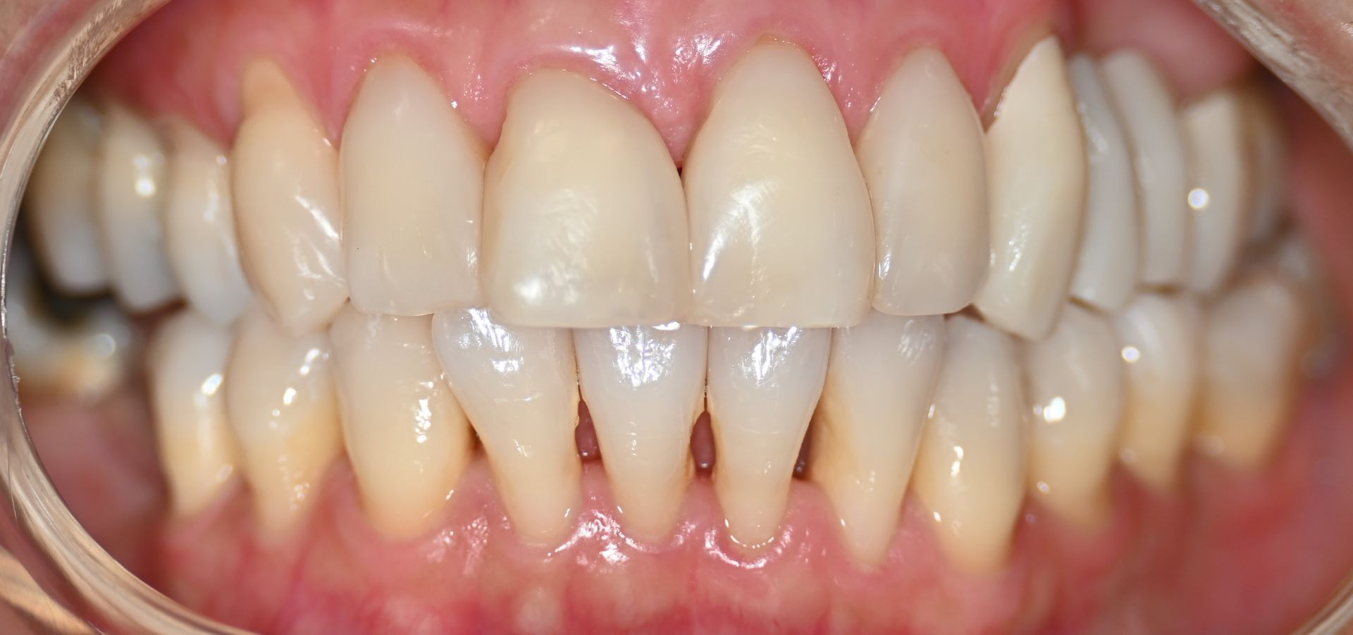 A close up of a person 's teeth in a mouth guard.