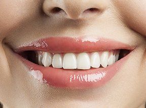 Dental Implants, Teeth Whitening, & Tooth Extraction in Gainesville, FL