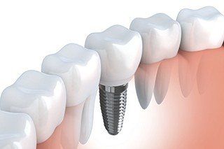 Teeth Whitening, Tooth Extraction, & Root Canals in Gainesville, FL