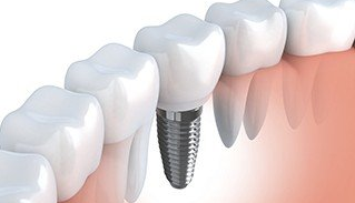 Dental Implants in Gainesville, FL