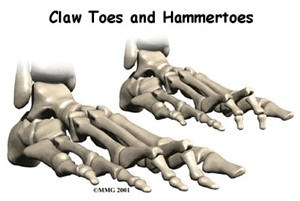 Claw Toes/Hammer Toes | Treatments | Eastpoint Podiatry