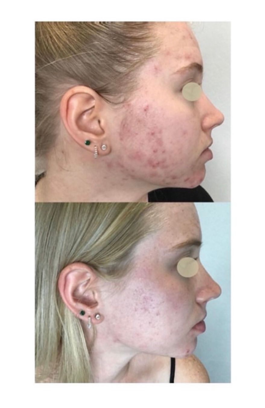 Face Acne Before and After — Johnson City, TN — RNA Medical Aesthetics