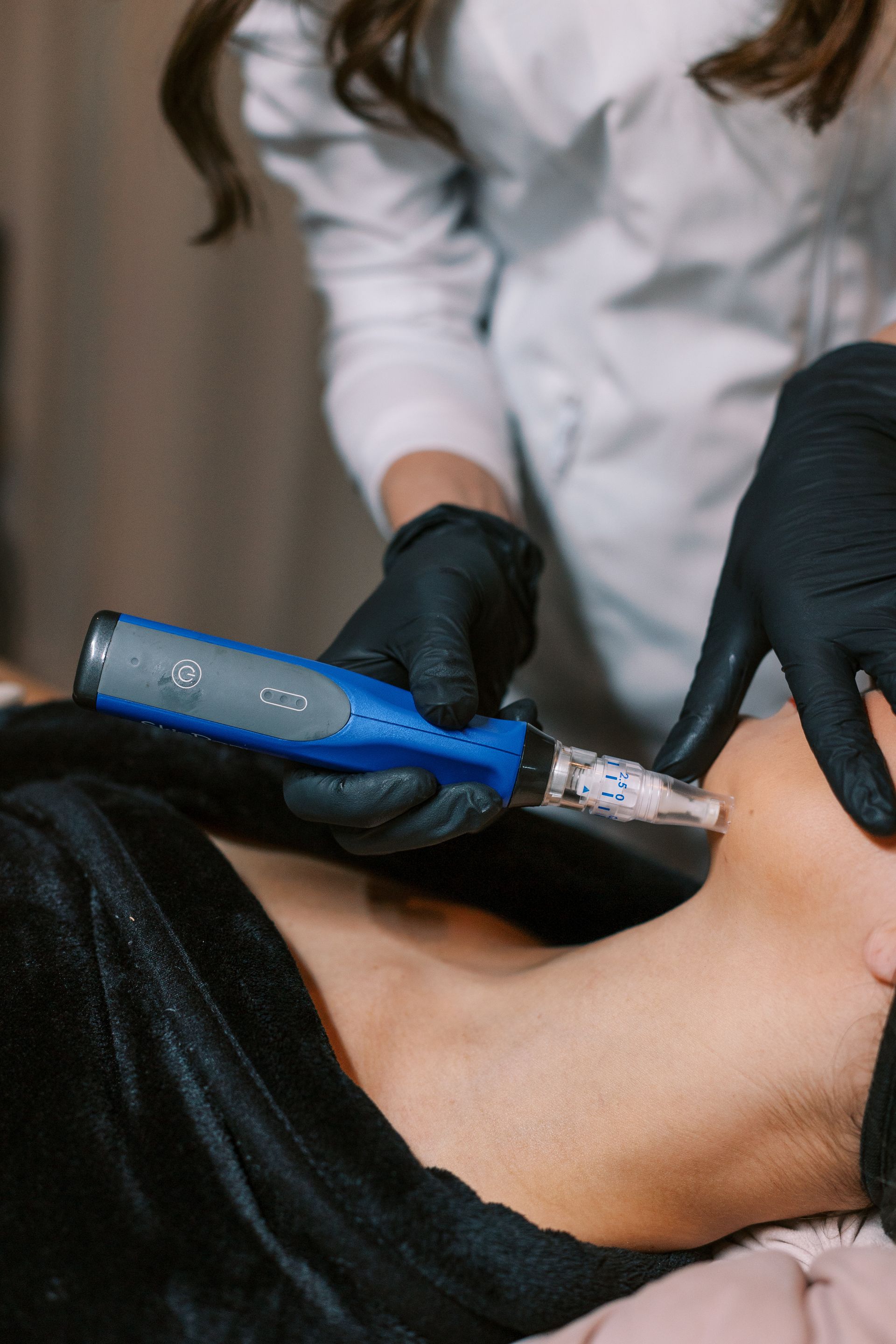 Microneedling — Johnson City, TN — RNA Medical Aesthetics Microneedling — Johnson City, TN — RNA Medical Aesthetics