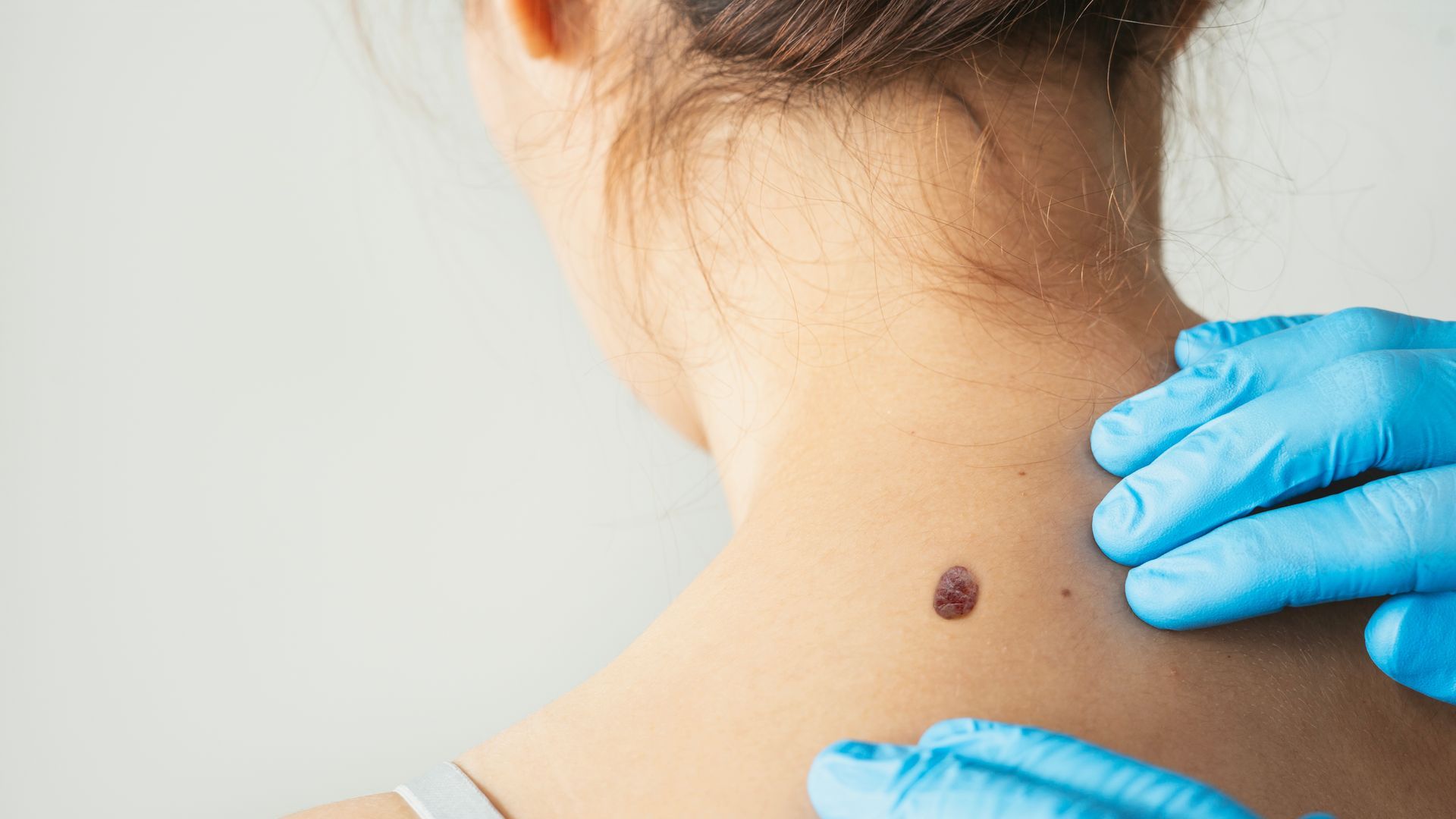 Benign Lesions — Johnson City, TN — RNA Medical Aesthetics Benign Lesions — Johnson City, TN — RNA Medical Aesthetics