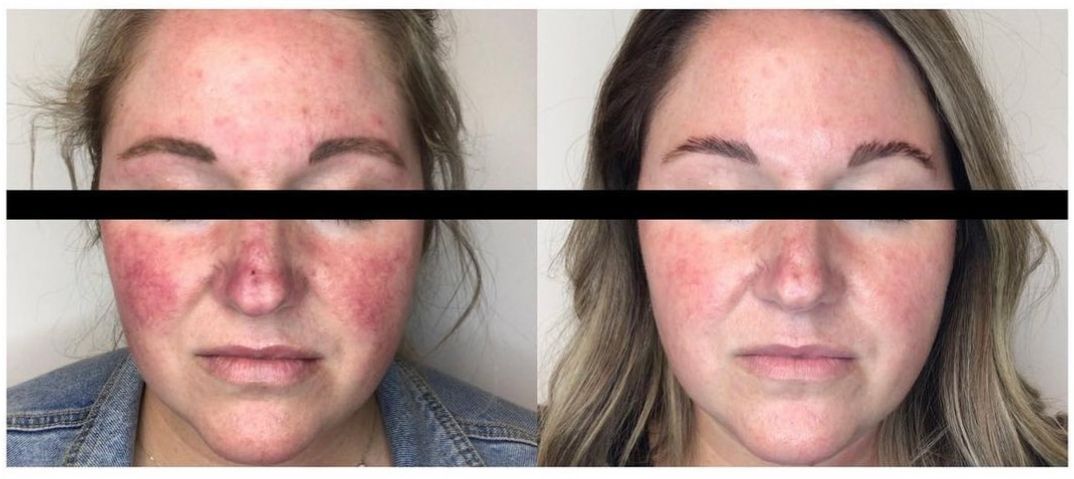 Lumecca Before and After — Johnson City, TN — RNA Medical Aesthetics