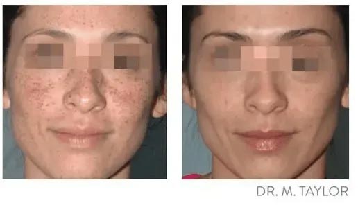 Lumecca — Johnson City, TN — RNA Medical Aesthetics