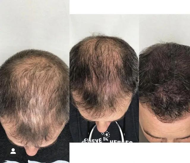 Hair Removal — Johnson City, TN — RNA Medical Aesthetics