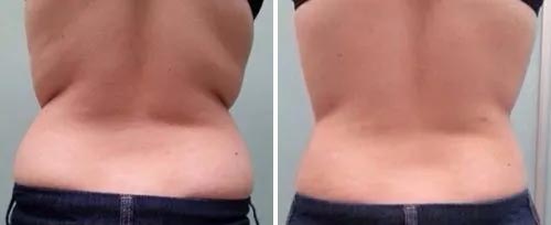 Liposuction in Johnson City, TN  Caudle Medical Spa, Cosmetic Surgery, and  Laser Aesthetics