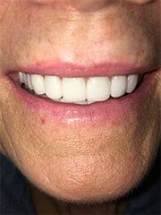 Full Mouth Reconstruction - After — Preventative care in Las Vegas, NV