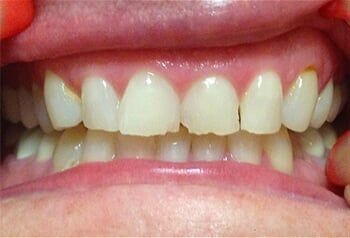 Full Mouth Reconstruction - Before — Preventative care in Las Vegas, NV