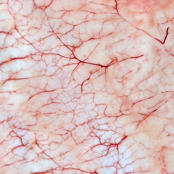 Autoimmune Vasculitis close up of Inflammation of the blood vessels on the skin