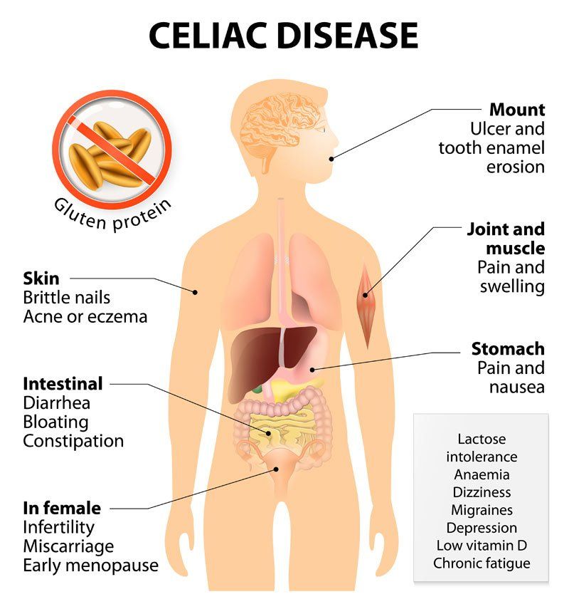 What is Celiac Disease? An Illustration Showing Common Symptoms of Celiac Disease