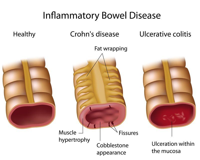 What is Inflammatory Bowel Disease? Common Symptoms of IBD
