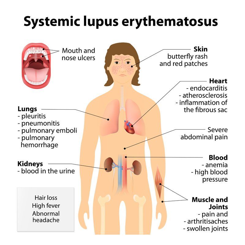 What is Systemic Lupus Erythematosus? Common Symptoms for Lupus