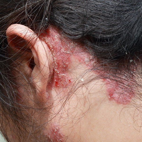 What is Psoriasis (Psoriatic Arthritis (PsA)) Woman with Psoriasis Symptoms Behind Her Ears