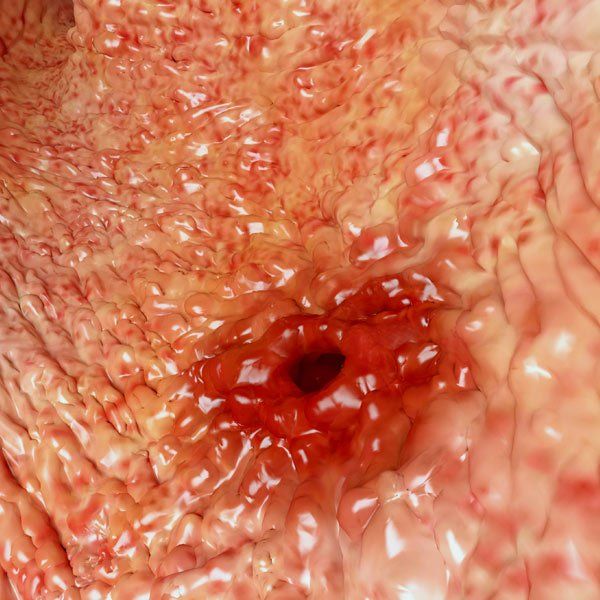 Close up of a Stomach Ulcer
