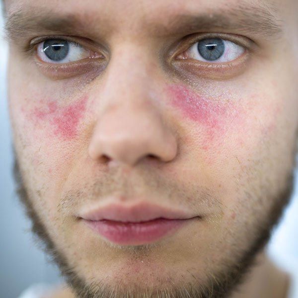Man with skin rashes from Systemic Lupus Erythematosus