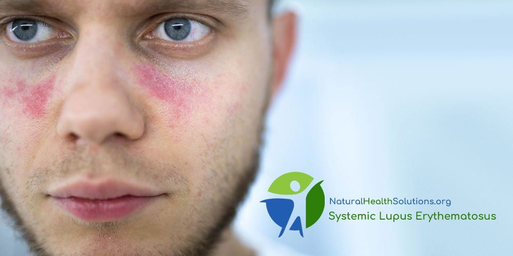 Lupus Treatments Natural Health Solutions