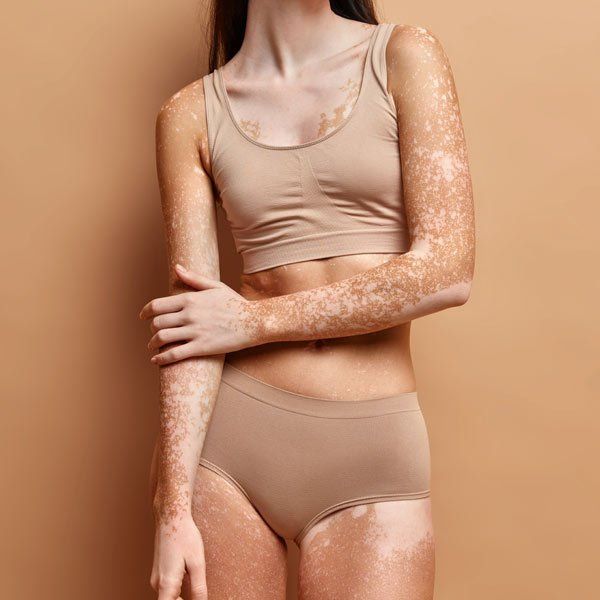 Woman with white blotches on her skin from Addison's Disease