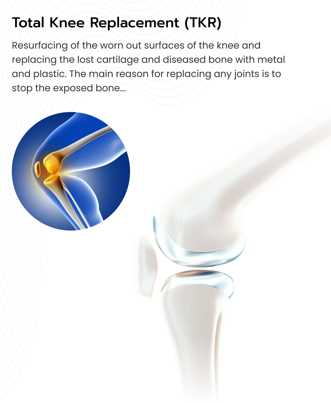 Total Knee Replacement