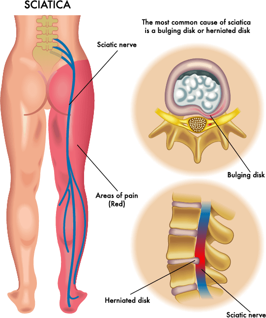 Sciatica and disc pain treatment