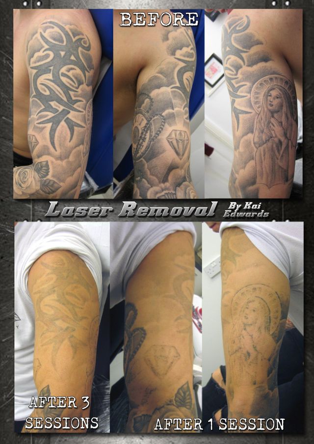 Share 94+ about laser tattoo removal after 3 sessions unmissable -  .vn