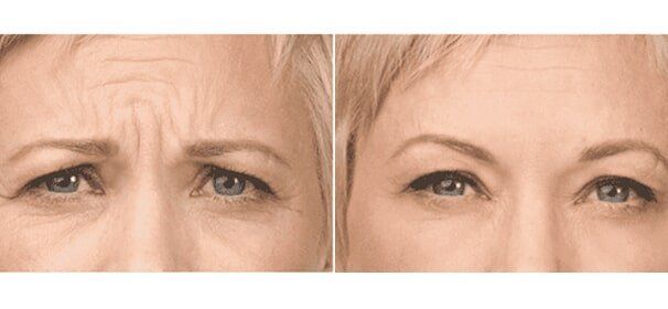 Before And After Of Woman — Botox  in Baytown, TX