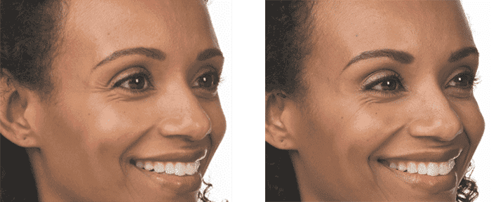 Before And After Face — Botox  in Baytown, TX
