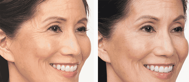 Before And After Face Of Girl — Botox  in Baytown, TX