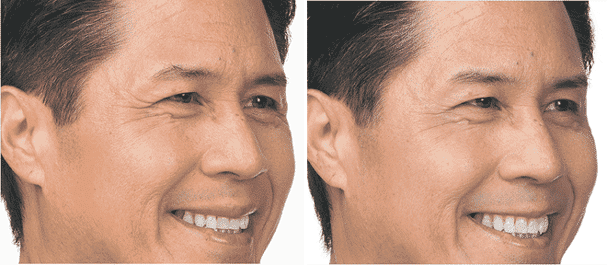 Before And After Face Of Man — Botox  in Baytown, TX