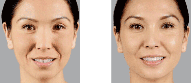 Before And After Face — Hyaluronic Acid Fillers  in Baytown, TX