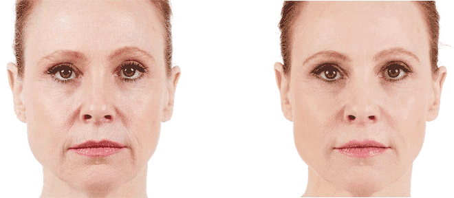 Before And After Face Of Woman — Hyaluronic Acid Fillers  in Baytown, TX