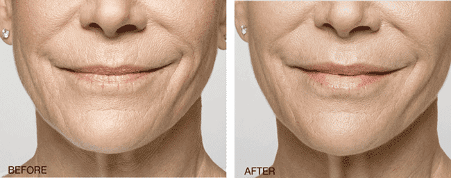 Before And After Smiling Face — Hyaluronic Acid Fillers  in Baytown, TX