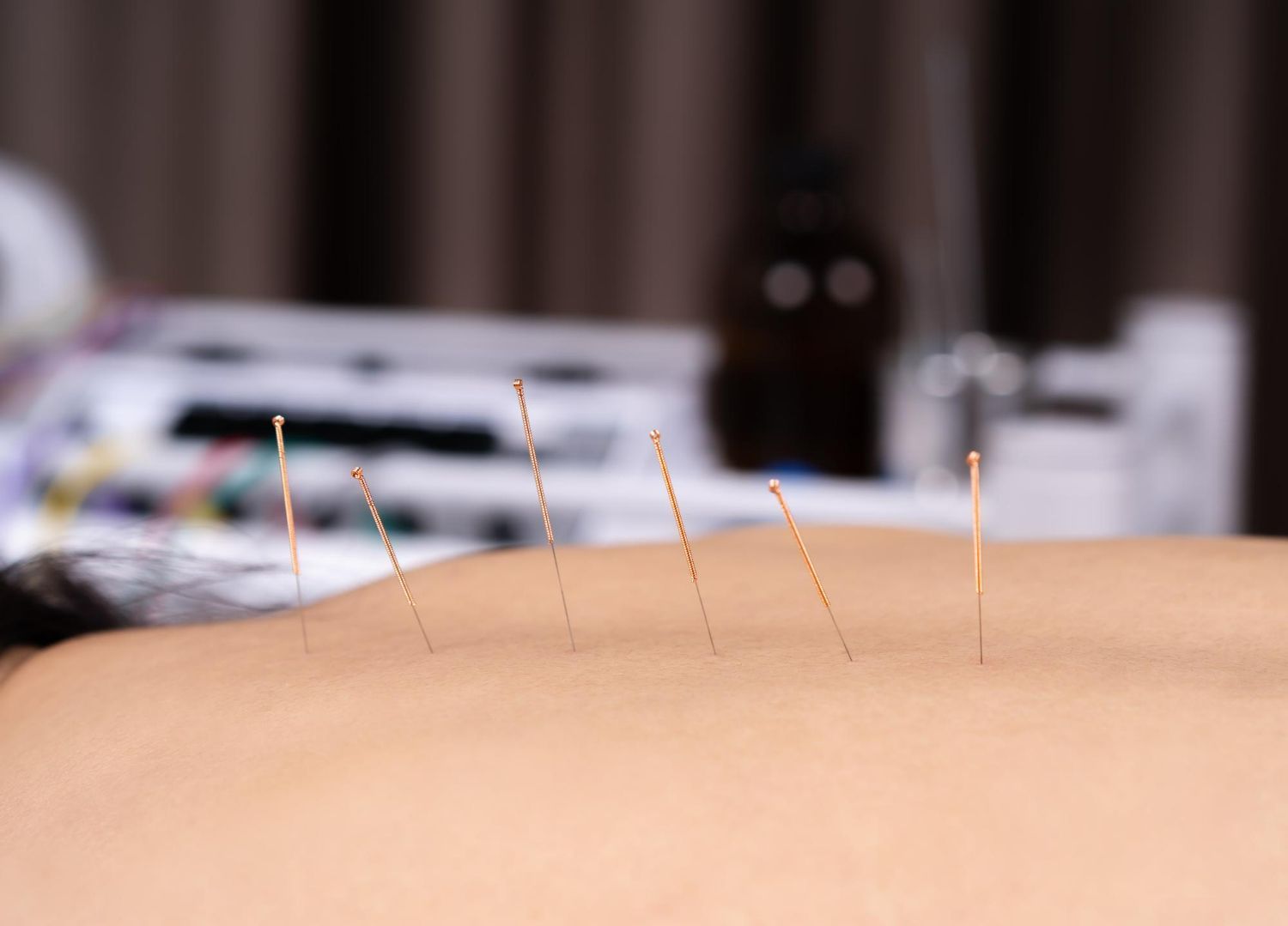 A person is getting acupuncture on their back.