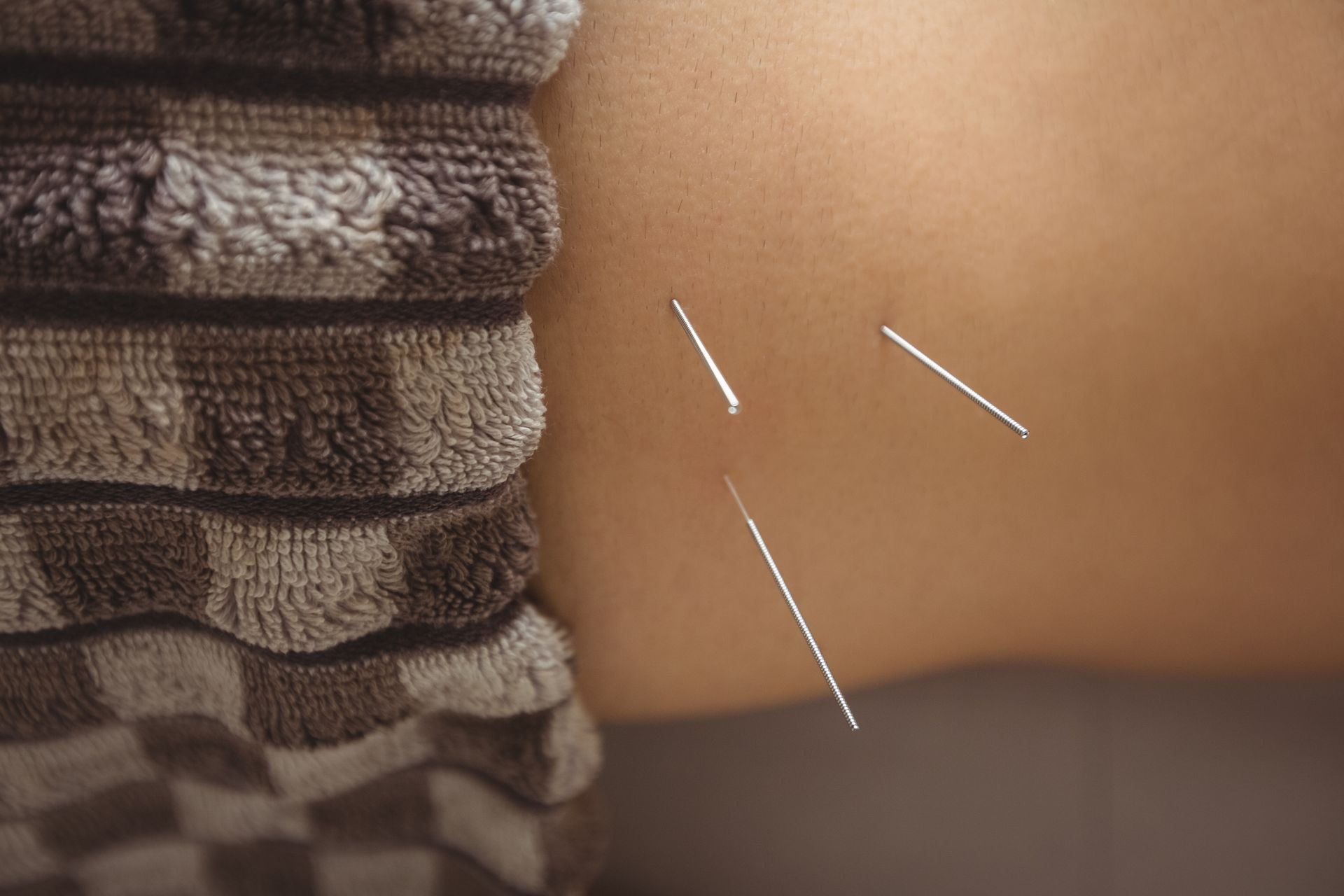 A person is getting acupuncture on their back.