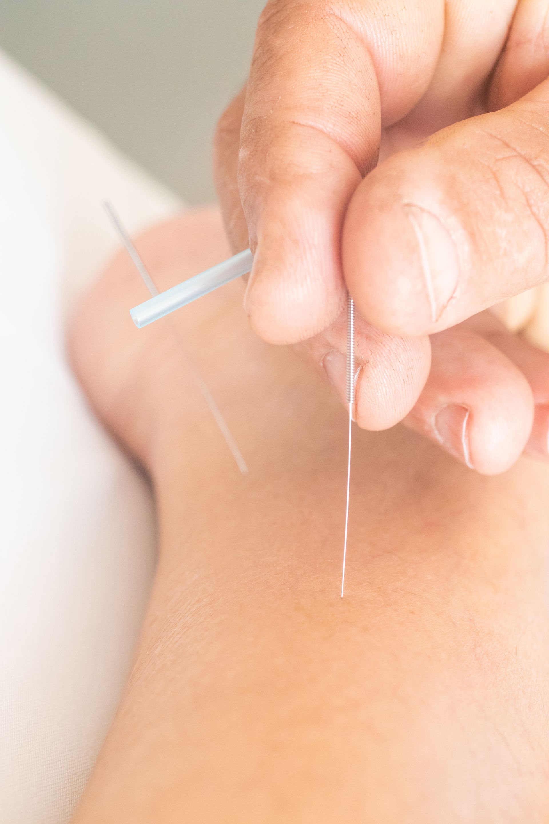 A person is getting acupuncture on their back.