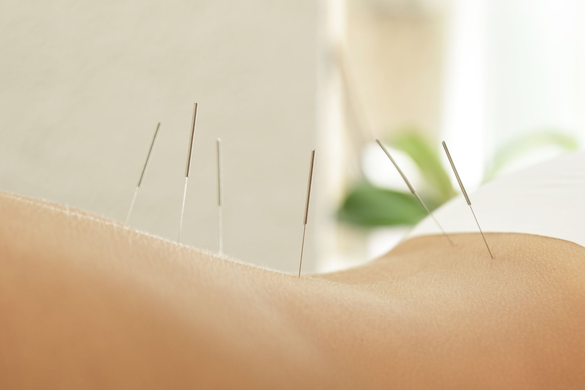 A person is getting acupuncture on their arm.