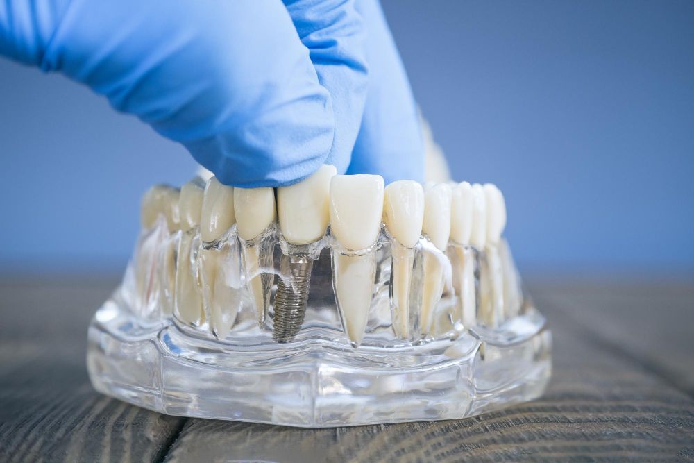Gloved hand holding a tooth on a dental model, demonstrating dental implants.