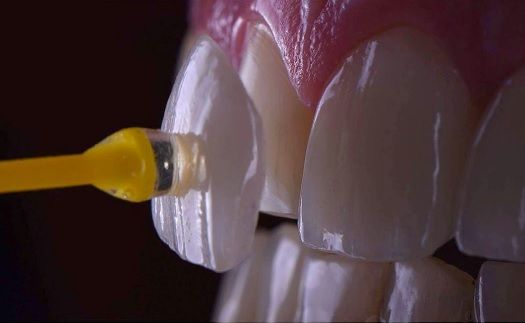 Close-up of dental veneers being cleaned with a yellow applicator.