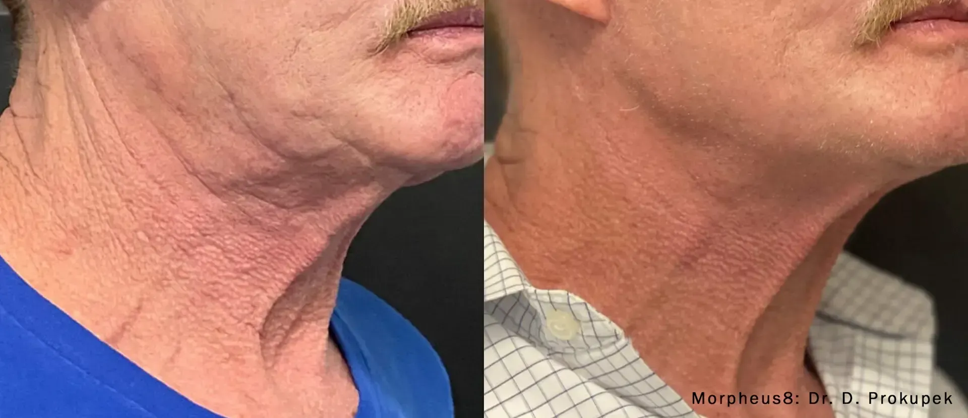 Neck lift before and after. Skin on the neck is wrinkled on the left and smooth on the right.