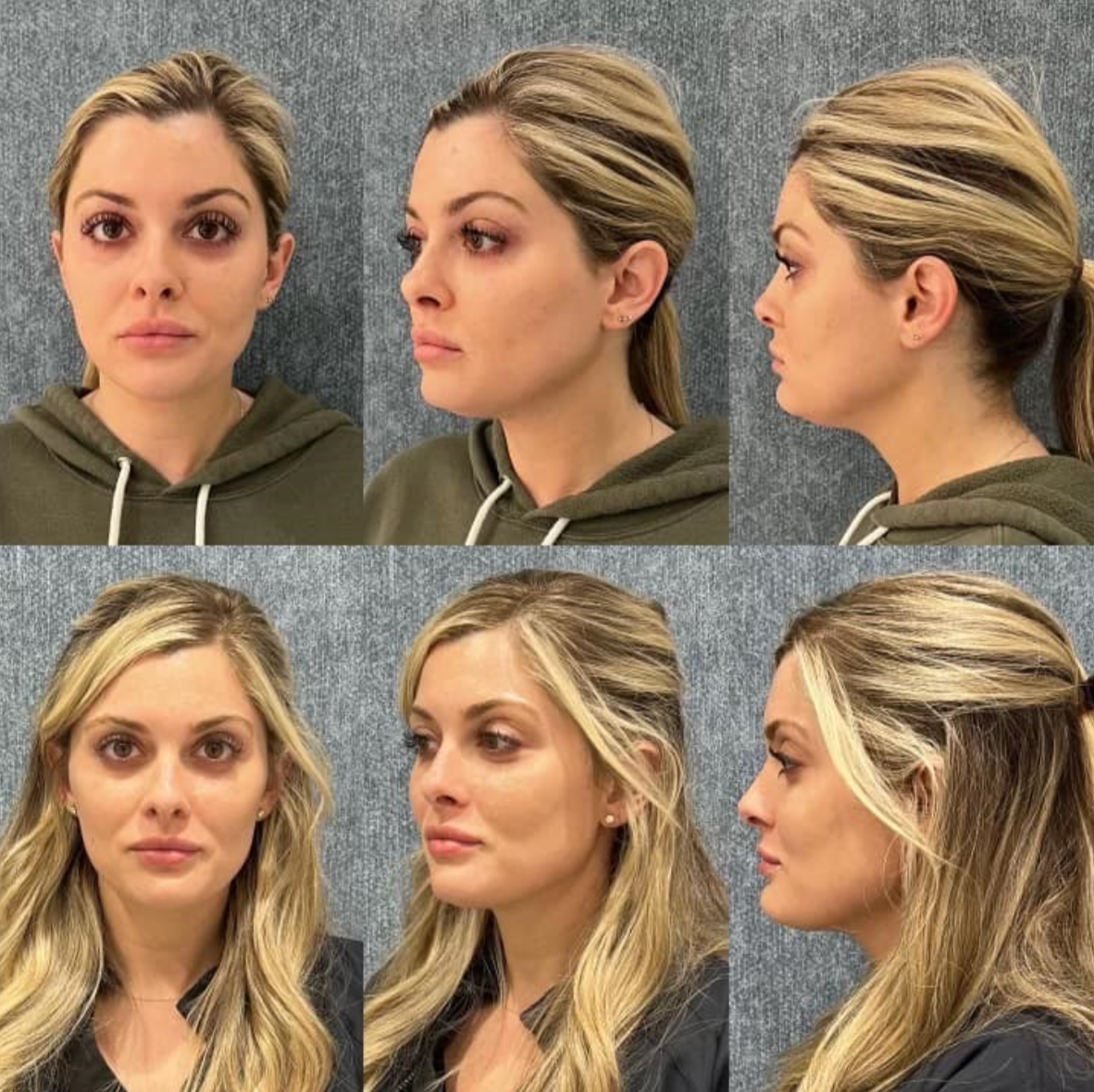 Before and after shots of a patient with Kybella treatments near Lexington, Kentucky (KY)