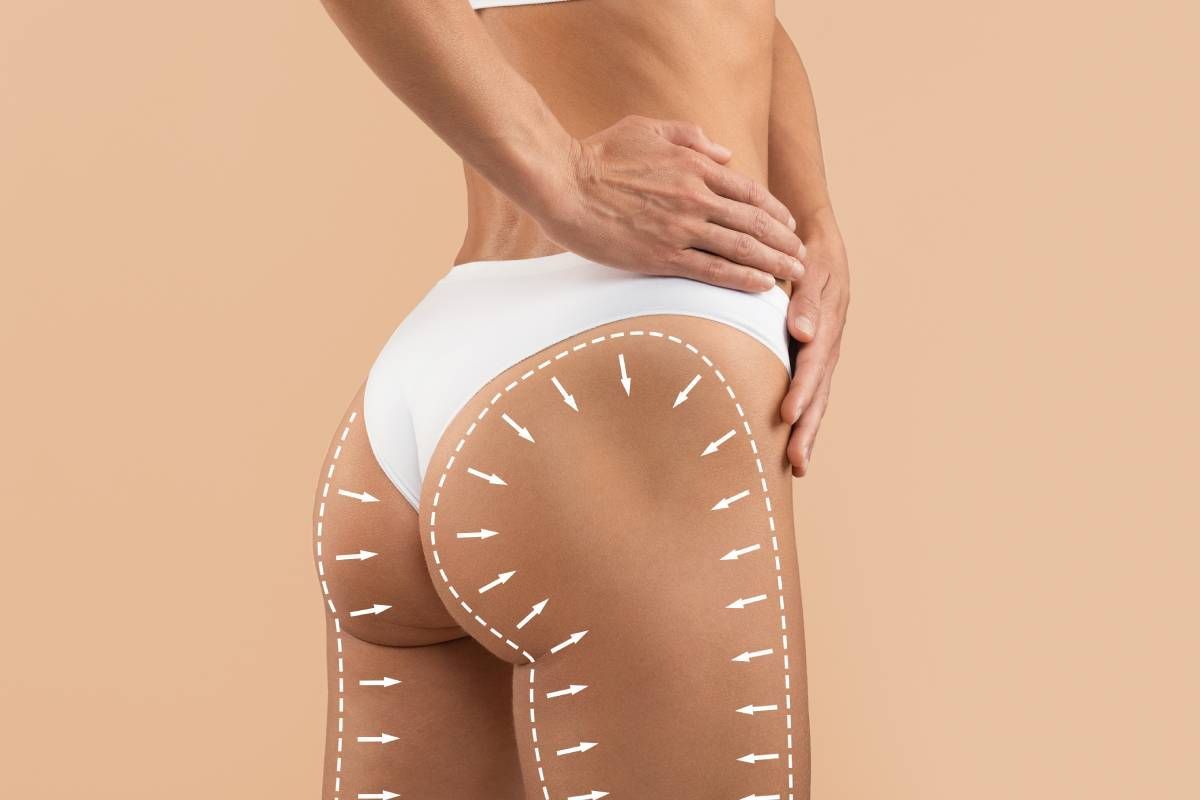 A female patient with arrows showing how cool sculpting lasts on buttocks near Lexington, Kentucky (KY)