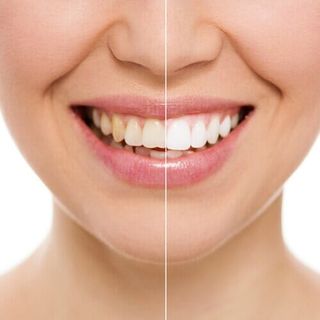 Bitewing — Before and After Whitening in Tampa, FL
