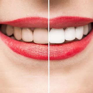 Smile — Before and After Teeth Cleaning in Tampa, FL